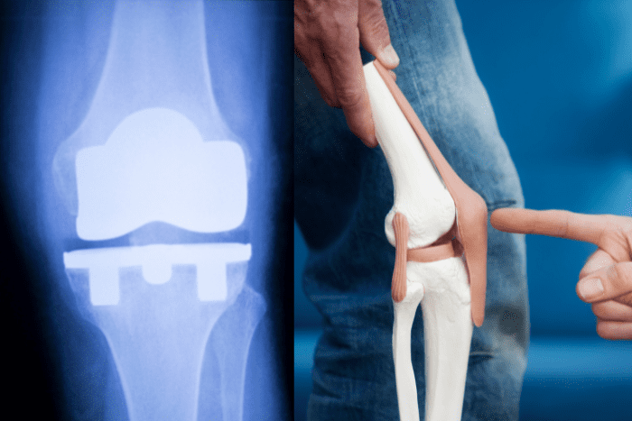 Advanced joint replacement surgery at Shiv Shahi Hospital, Ambernath, for pain relief and improved mobility.